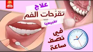 علاج قرح الفم في نصف ساعة فقط