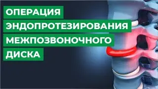 Операция по эндопротезированию межпозвонкового диска
