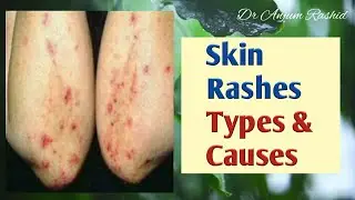 Skin Rashes Types, Causes and Identification