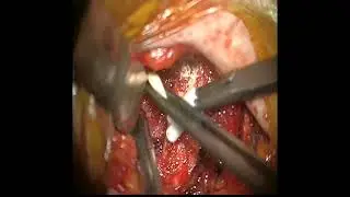 ventriculopleural shunt