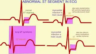 Abnormal ECG song