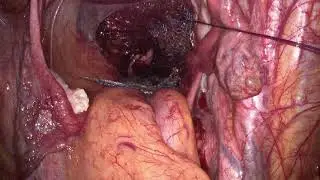 LAPAROSCOPIC RECTOPEXY