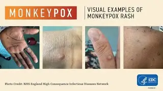 Monkeypox - What it is, Symptoms, Causes, and Treatment