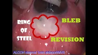 How to Revise a Bleb: Revision of a Nonfiltering Bleb