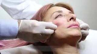 Face reshaping & wrinkle elimination with HYAcorp Face