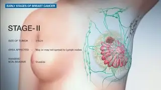 Stages of Breast Cancer