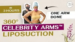 Celebrity Arms™ Liposuction | Immediate Results | Artlipo | Expert Dr. Thomas Su