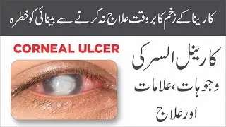 Corneal Ulcer |  زخم قرنیہ | Causes, Symptoms, and Treatment | Urdu/Hindi
