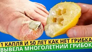 НЕТ ГРИБКА УЖЕ 50 ЛЕТ! ГРИБОК НОГТЕЙ СРАЗУ ИСЧЕЗ НАВСЕГДА!