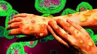 Mpox: TUDO que você precisa saber
