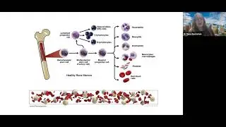 Webinar – INQOVI®: Everything you want to know about it and other MDS treatments.