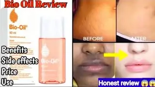 HOW TO REMOVE SCARS| HONEST REVIEW OF BIO OIL  || चेहरे पर धब्बे जल्दी कैसे हटाएं?