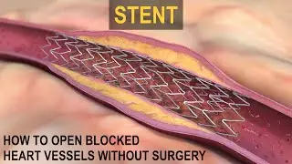 What is a STENT?