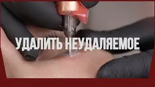 Онлайн-курс по удалению татуажа и тату ремувером!