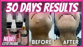 COTA SKIN [COTA DELUXE] 30 DAYS REVIEWS/RESULTS(PICTURES INCLUDED) PCOS