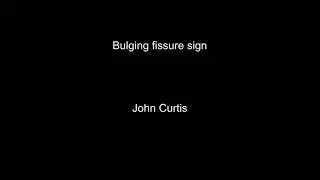 Bulging Fissure Sign explained on chest x-ray and CT scan