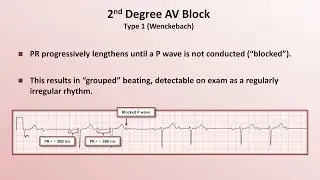 Intro to EKG Interpretation - AV Block
