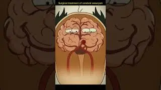treatment of cerebral aneurysm