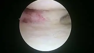 R knee partial meniscus resection menisectomy 12 22 22 KM