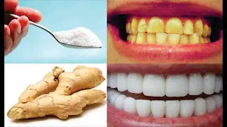 Тісті ағарту жолы / teeth whitening methods / Методы отбеливания зубов