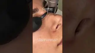 Coolfrax Skin Pigmentation and Pore Reduction