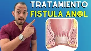 🔴 𝗙𝗜𝗦𝗧𝗨𝗟𝗔 𝗔𝗡𝗔𝗟 Síntomas, Causas y Tratamiento