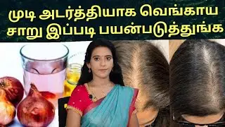 முடி அடர்த்தியாக வெங்காய சாறு இப்படி பயன்படுத்துங்க Onion juice benefits for hair growth /Dr.Mythili