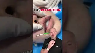 Lip Reduction Surgery is Real 👄 