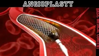 Angioplasty | Blood Vessel 