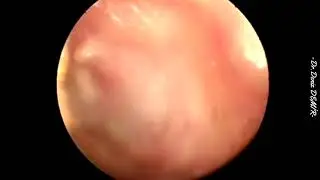 Timpanoplasti (Kulak Zarı Deliği Ameliyatı)-Overlay Tympanoplasty-Dr.Deniz Demir