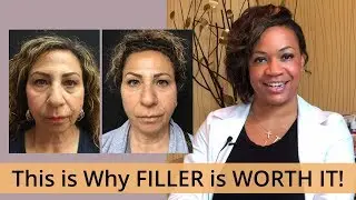 Is FILLER WORTH IT? [ Cosmetic Physician Injector Weighs In]