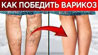 What are varicose veins and how to get rid of them? / The main causes of varicose veins and their...