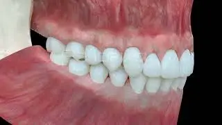 Vídeo 3D Férula de descarga para tratar el bruxismo - Tráiler