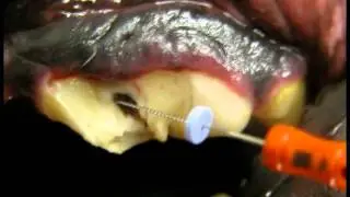 Fractured Teeth