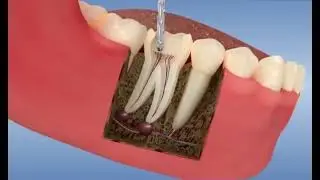 La DÉVITALISATION , c’est quoi?