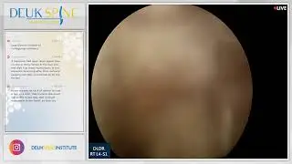 Laser Spine Surgery for Discogenic Lower Back Pain from Herniated Disc L4-S1