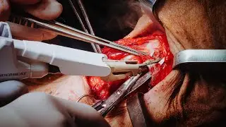 Functional Total Laryngectomy by Kathryn M. Van Abel, MD | Preview