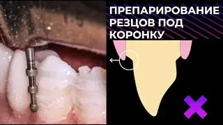 ПРЕПАРИРОВАНИЕ 6 ЗУБОВ ПОД КОРОНКУ