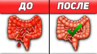 Схема лечения язвенного колита | ЯЗВЕННЫЙ КОЛИТ