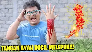 TANGAN AYAH BOCIL TERBAKAR PETASAN SAMPAI MELEPUH!!! BOCIL KASIHAN PANGGIL AMBULANCE!