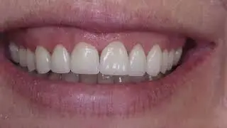 Barbie smile and copying it for our patient