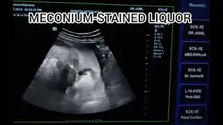 Meconium-stained liquor ultrasound