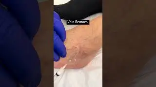 Vein Removal