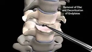 Cervical Surgery Animation
