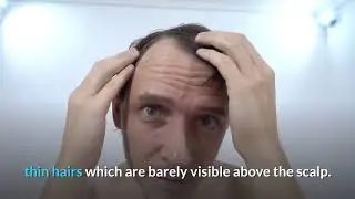 Understand baldness and how you can reverse it?