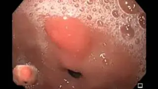 Pre-pyloric Hyperplastic Polup