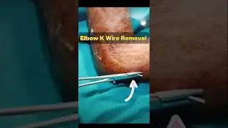 Elbow K Wire Removal Process 🔥🔥 