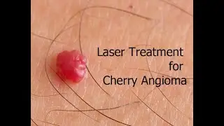 Cherry Angioma Laser Removal