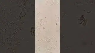 Trichomonas vaginalis in the urine 