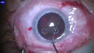 Single-handed bevel-down cataract flip